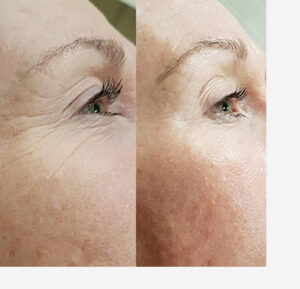 DMK Enzyme Facial Therapy Results Mittagong